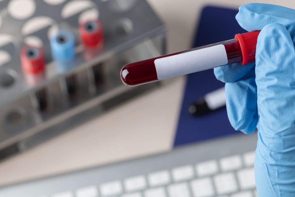 Surgeon Holding Blood Test