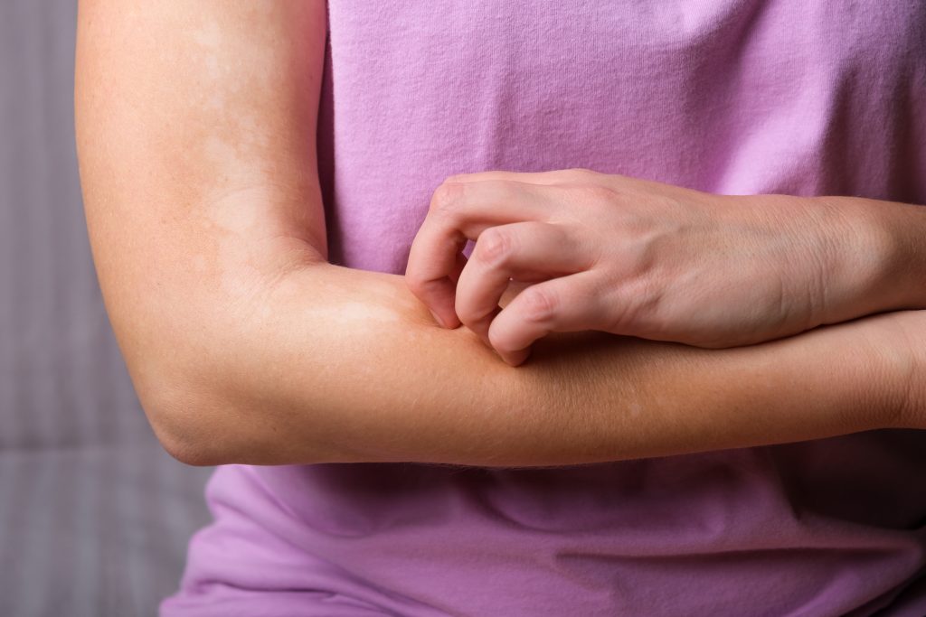 Young Woman Scratches Her Hands From Itching Allergic Dermatitis Skin Disease Vitiligo Neurodermatitis Disease Eczema Allergy Rash Healthcare Medical
