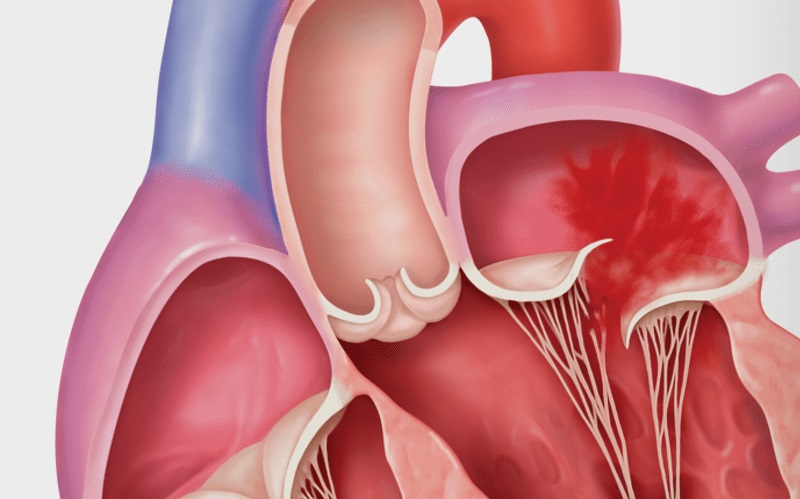 Insuficienta Mitrala Primara