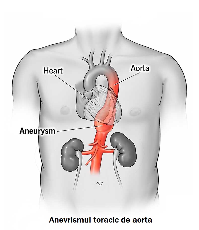 Anevrism Toracic De Aorta