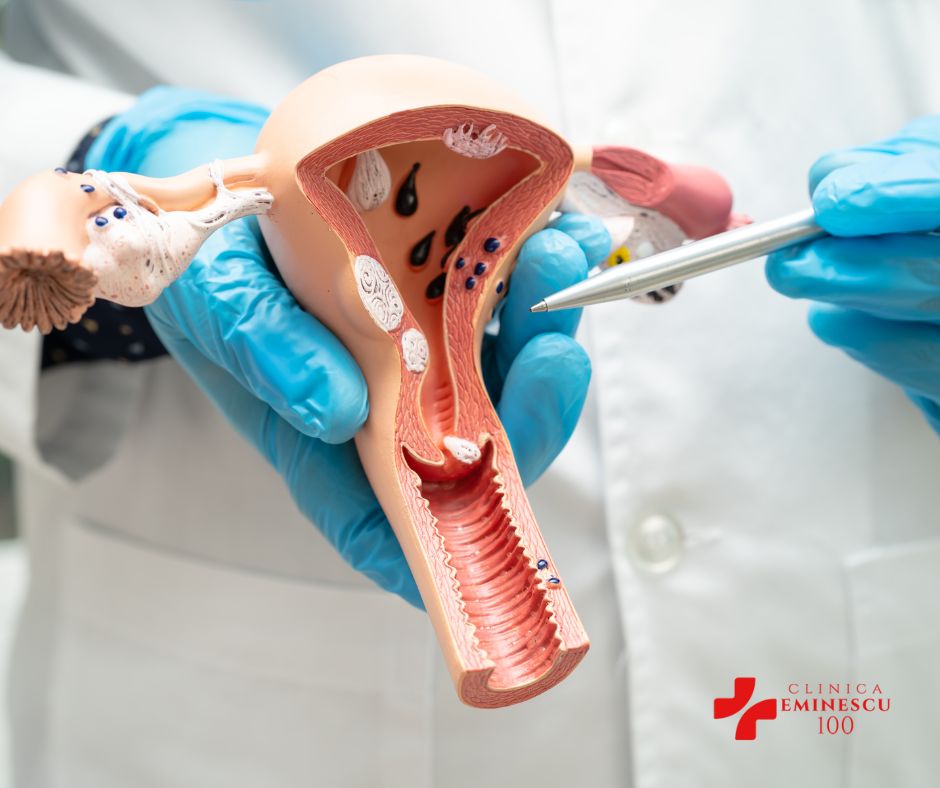 Fibrom Uterin Clinica Eminescu 100