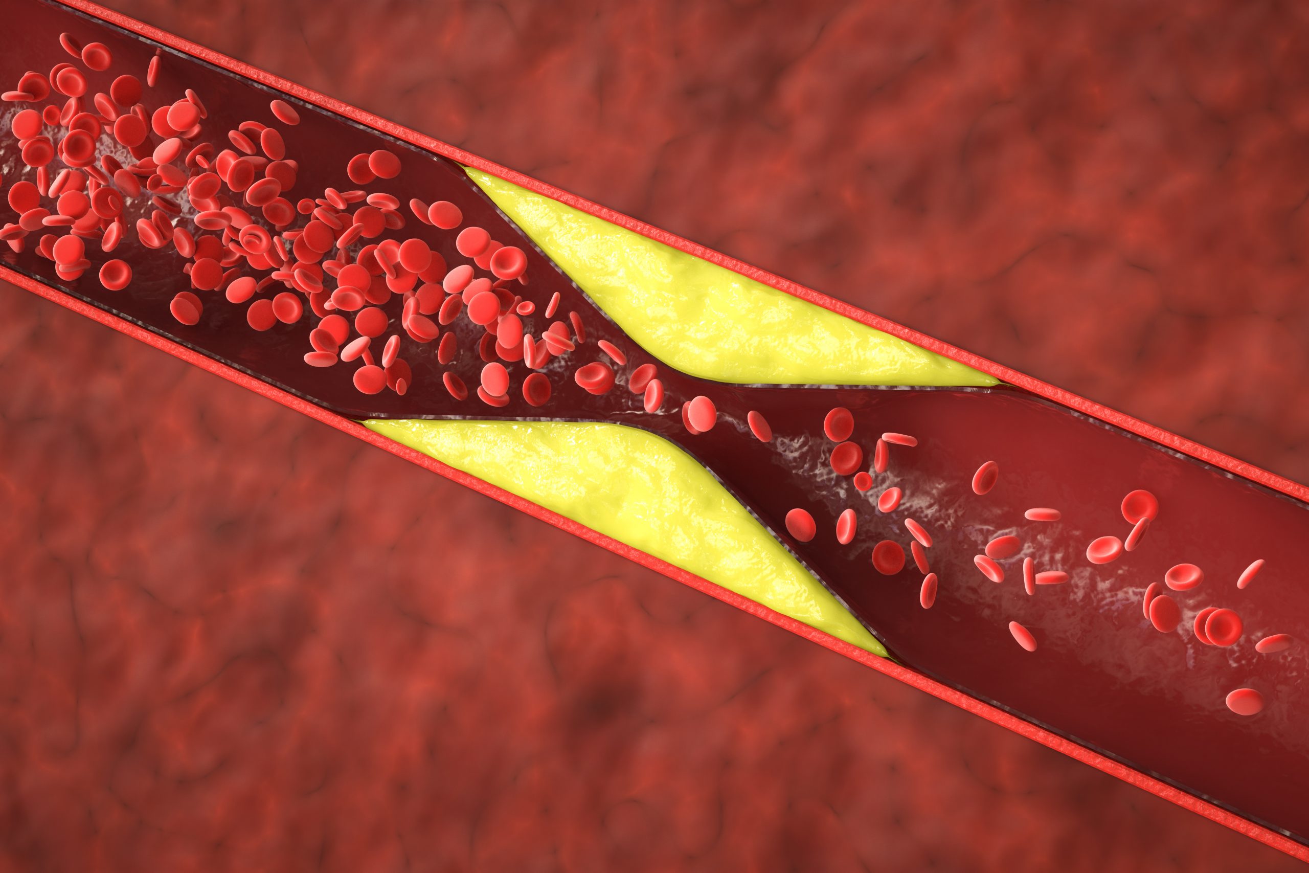 3d Rendering Atherosclerosis With Cholesterol Blood Plaque Vessel Cause Coronary Artery Disease Scaled